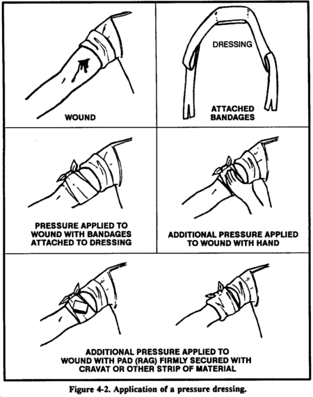Figure 4-2. Application of a pressure dressing