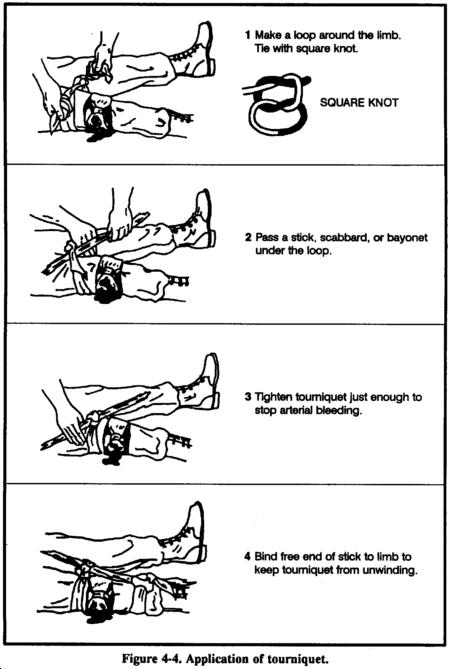 Figure 4-4. Application of tourniquet